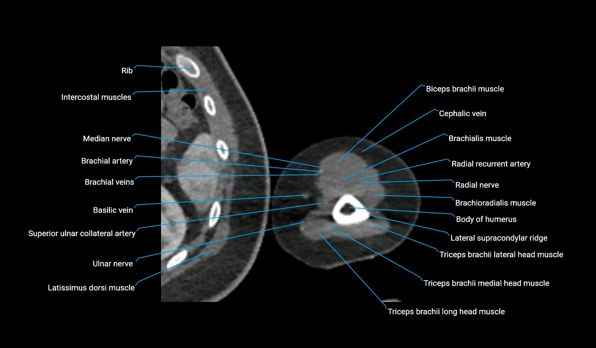CT upper arm axial  cross sectional anatomy labelled radiology image -00334.webp